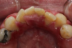 Figure 4b: Gingival overgrowth caused by a patient being on nifedipine and having poor oral hygiene Figure 4b: Gingival overgrowth caused by a patient being on nifedipine and having poor oral hygiene