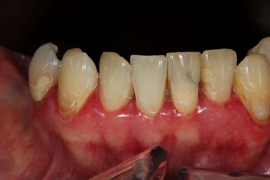 Figure 4c: The result after gingival overgrowth was treated with the Solea dental laser without the need for sutures and no bleeding (because of the laser&rsquo;s cauterization ability)