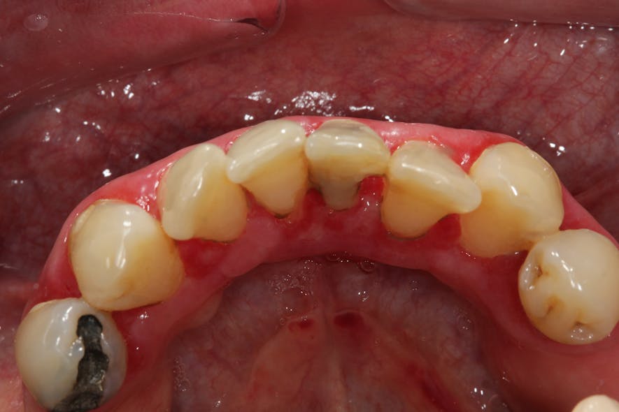 Figure 4d: The result after gingival overgrowth was treated with the Solea dental laser without the need for sutures and no bleeding (because of the laser&rsquo;s cauterization ability)