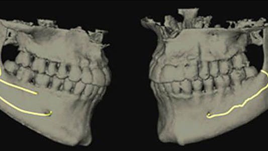 Fig 2 Bifid And Trifid Canal Image 61d75ef3bdce5