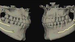 Fig 2 Bifid And Trifid Canal Image 61d75ef3bdce5 Fig 2 Bifid And Trifid Canal Image 61d75ef3bdce5