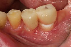 Figure 3: Lack of keratinized tissue Figure 3: Lack of keratinized tissue