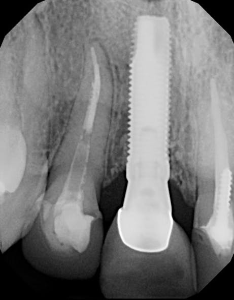 Figure 4: Poor bone-to-implant contact