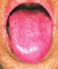 Figure 1: Atrophic tongue in a patient with pernicious anemia due to vitamin deficiency Figure 1: Atrophic tongue in a patient with pernicious anemia due to vitamin deficiency