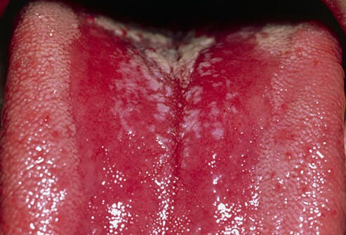Figure 3: Thrush fungal infection in an immunodeficient patient
