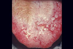 Figure 4: Oral lichen planus which can manifest in other areas besides the tongue Figure 4: Oral lichen planus which can manifest in other areas besides the tongue