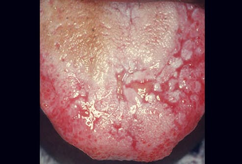 Figure 4: Oral lichen planus which can manifest in other areas besides the tongue