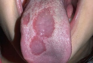 What Those Spots on Your Tongue Mean