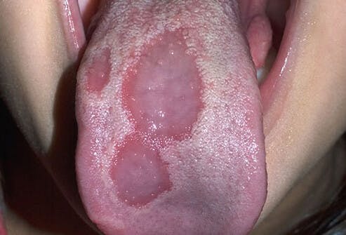 Figure 5: Geographic tongue in a patient with leaky gut and chronic inflammation