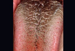 Figure 6: Black, hairy tongue from poor oral hygiene and smoking Figure 6: Black, hairy tongue from poor oral hygiene and smoking