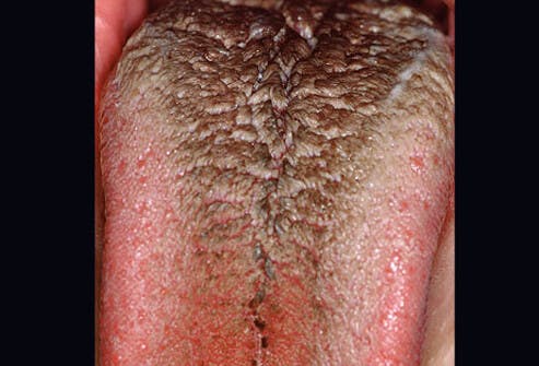 Figure 6: Black, hairy tongue from poor oral hygiene and smoking