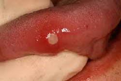 Figure 7: Aphthous ulcer (minor) frequently found on the lateral border of the tongue