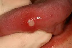 Figure 7: Aphthous ulcer (minor) frequently found on the lateral border of the tongue Figure 7: Aphthous ulcer (minor) frequently found on the lateral border of the tongue
