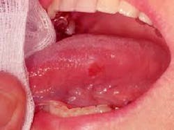 Figure 8: Erythroplakia causing an ulcer in a patient and that should be biopsied Figure 8: Erythroplakia causing an ulcer in a patient and that should be biopsied