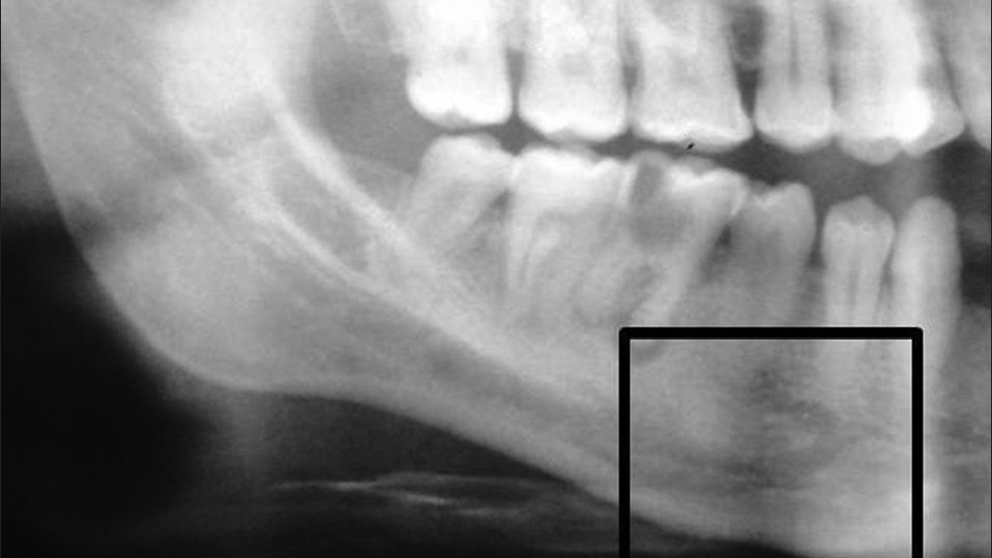 Dental Implant Pain When Nothing Wrong With Implant