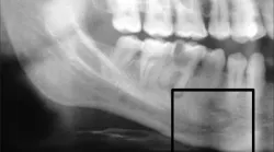 Dental Implant Pain When Nothing Wrong With Implant
