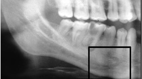 Dental Implant Pain When Nothing Wrong With Implant