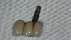 Failed part of an implant bridge in a patient with penicillin allergy Failed part of an implant bridge in a patient with penicillin allergy