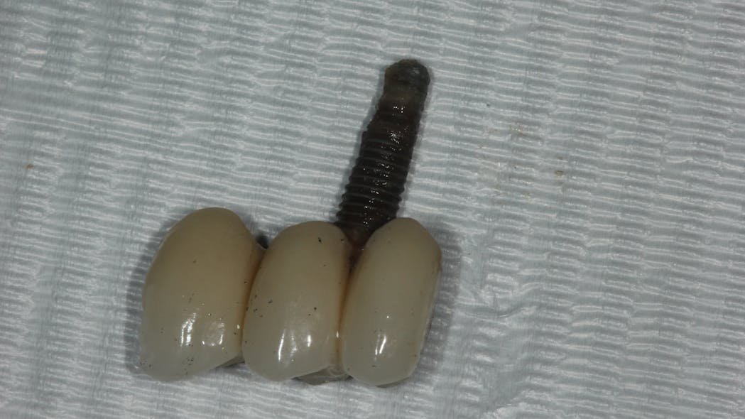 Failed part of an implant bridge in a patient with penicillin allergy