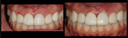 Figure 1: Before-and-after photos showing the results of functional crown lengthening using a 9.3-micron CO2 laser to recreate space around crown and veneer restorations that have violated the biologic width, causing inflammation and bleeding in the surrounding gum tissue.