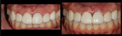 Figure 1: Before-and-after photos showing the results of functional crown lengthening using a 9.3-micron CO2 laser to recreate space around crown and veneer restorations that have violated the biologic width, causing inflammation and bleeding in the surrounding gum tissue. Figure 1: Before-and-after photos showing the results of functional crown lengthening using a 9.3-micron CO2 laser to recreate space around crown and veneer restorations that have violated the biologic width, causing inflammation and bleeding in the surrounding gum tissue.