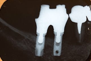 Spline® Implants