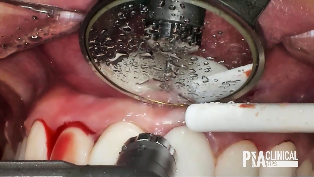 Functional crown lengthening around bleeding crown and veneer
