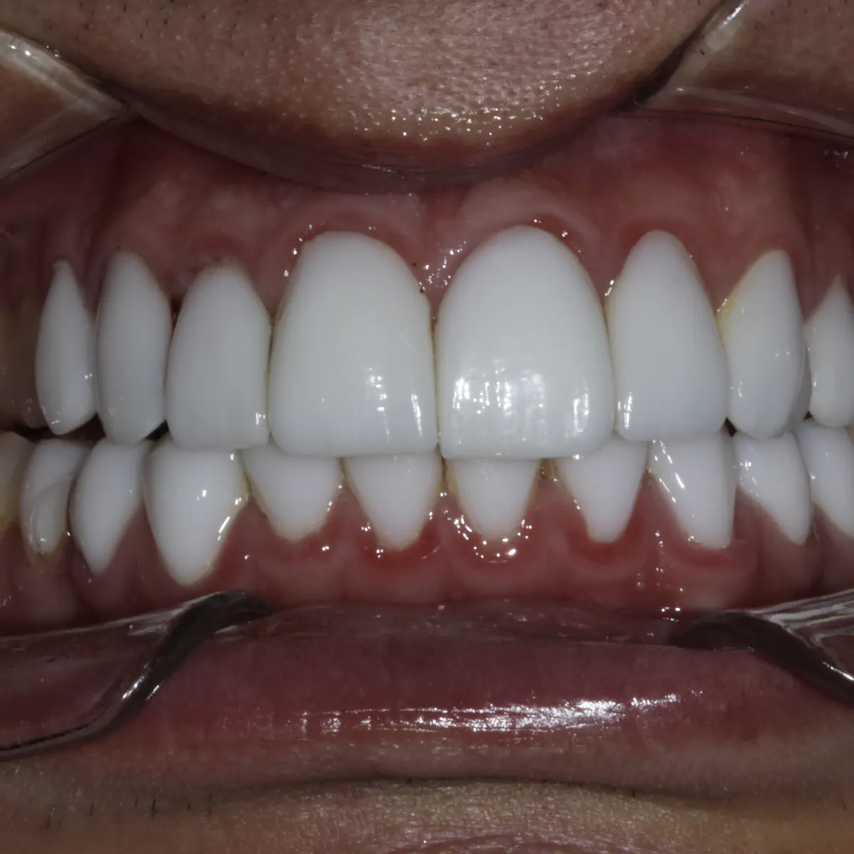 Ferrule: Why is it important, and how much do we need? | Perio Implant ...