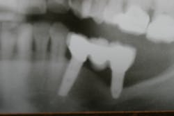 Figure 1: Radiograph of severe bone loss around a distal implant supporting an implant bridge Figure 1: Radiograph of severe bone loss around a distal implant supporting an implant bridge