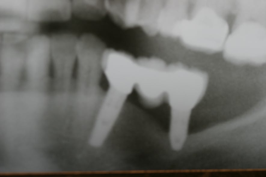 Figure 1: Radiograph of severe bone loss around a distal implant supporting an implant bridge