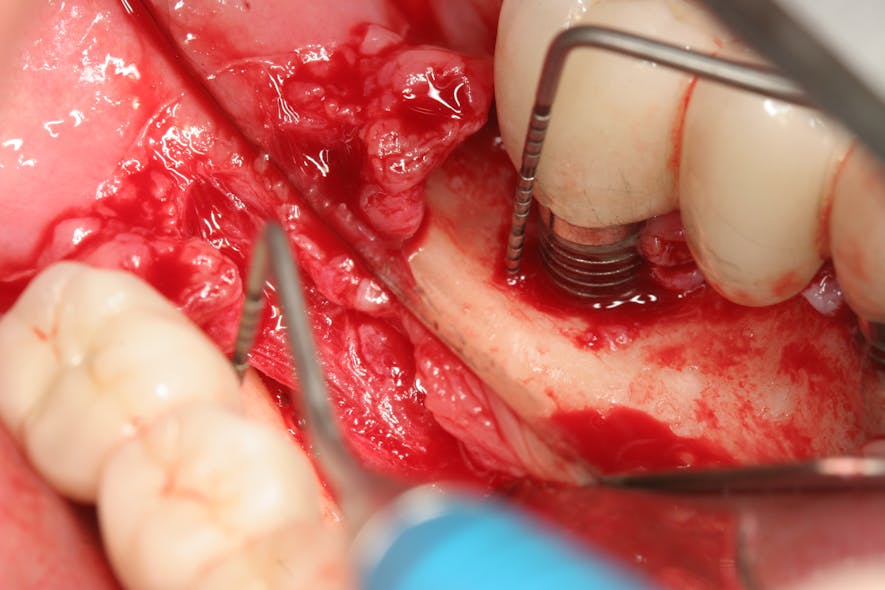 Figure 2: Poor surgical access to appropriately debride dental implant