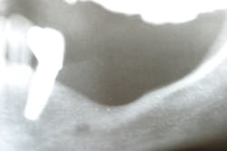 Figure 3: Loss of dental implant after regenerative surgery failed Figure 3: Loss of dental implant after regenerative surgery failed