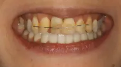 severe anterior bone defect