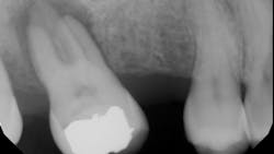 periapical radiolucency