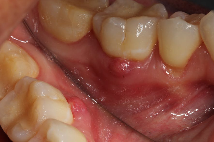Figure 1: Sinus tract formed with abscess on gingiva from infection