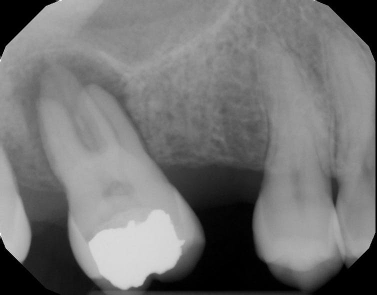 Figure 2: Periapical radiolucency (hole in bone) from infection within root canal system of tooth