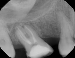 Figure 3: Root canal-treated tooth with bone fill after 12 months of healing Figure 3: Root canal-treated tooth with bone fill after 12 months of healing