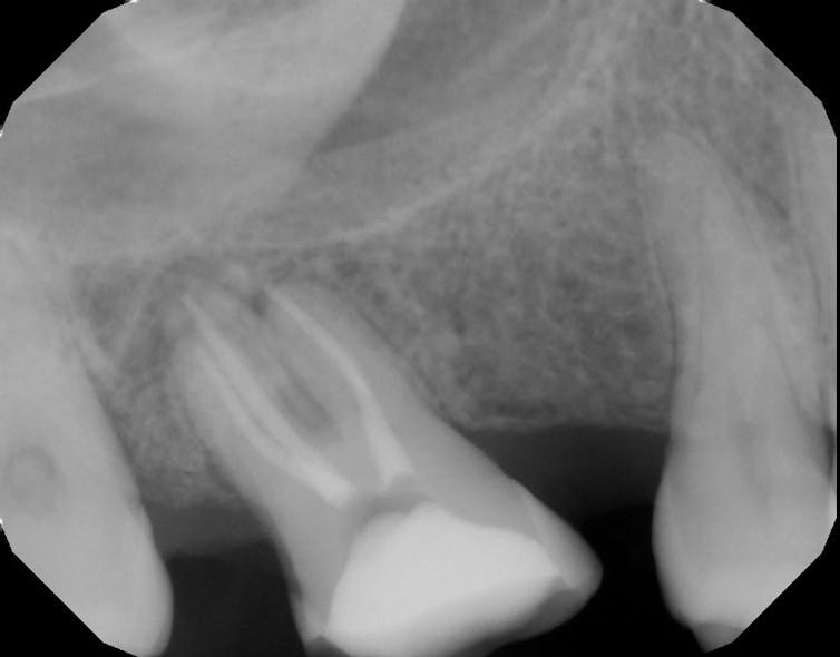 Figure 3: Root canal-treated tooth with bone fill after 12 months of healing
