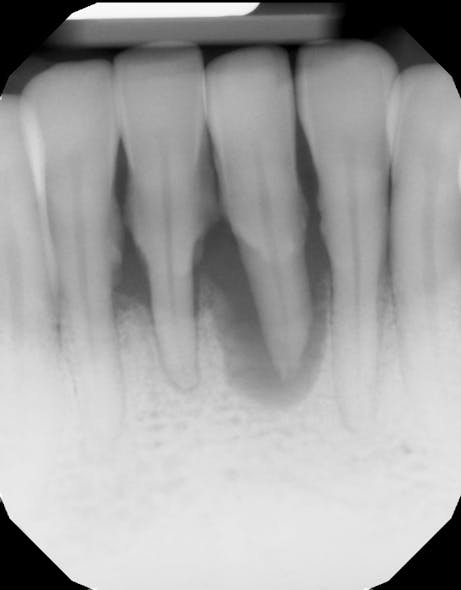 Figure 1: Initial radiograph of tooth with bone loss completely beyond apex