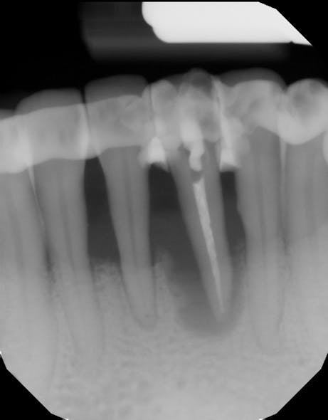 Figure 2: Radiograph after tooth had root canal therapy and was splinted