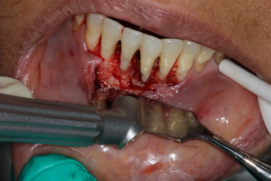 Figure 3: Detoxification of bone defect around the tooth with the Solea 9.3-micron CO2 laser