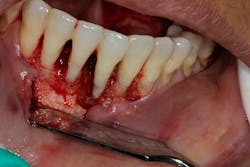 Figure 3a: Complete detoxification of the lesion and a clean bone defect Figure 3a: Complete detoxification of the lesion and a clean bone defect