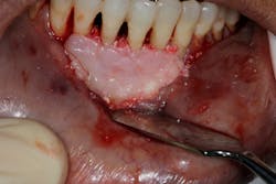 Figure 4: Bio-Oss Collagen bone graft and Bio-PRF biologic material used to regenerate defect Figure 4: Bio-Oss Collagen bone graft and Bio-PRF biologic material used to regenerate defect