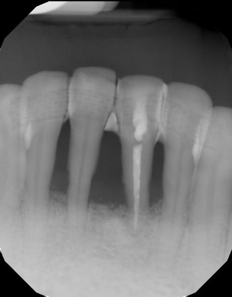 Figure 6: Radiograph three years later showing bone fill and defect resolution