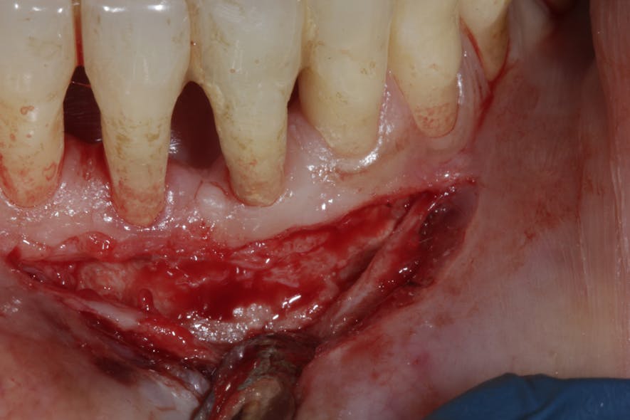 Figure 6a: Reentry three years later showing complete bone fill of initial lesion