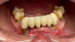Figure 1: A patient with opioid addiction leading to caries, gum disease, and tooth mobility