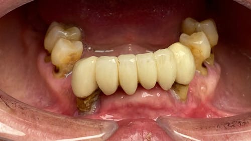 How Ozempic has the potential to cause halitosis