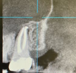 Figure 2: CBCT of same fractured tooth showing typical pattern of bone loss but no evidence of the root fracture itself Figure 2: CBCT of same fractured tooth showing typical pattern of bone loss but no evidence of the root fracture itself