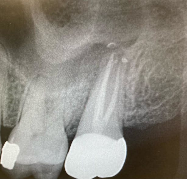 Figure 1: Periapical radiograph showing lateral defect around a tooth later diagnosed with a fracture