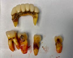 Figure 2: Extensive decay and bone loss requiring full-mouth extraction
